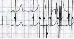 Ecg_verg.gif (26450 byte)