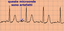 ecg_artef.gif (6017 byte)