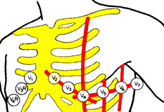 elettrodi_torace.gif (6122 byte)